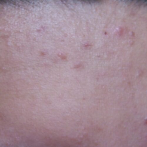 An example of heat rash self-care is a woman's forehead with obvious heat rash.