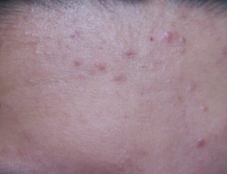 An example of heat rash self-care is a woman's forehead with obvious heat rash.