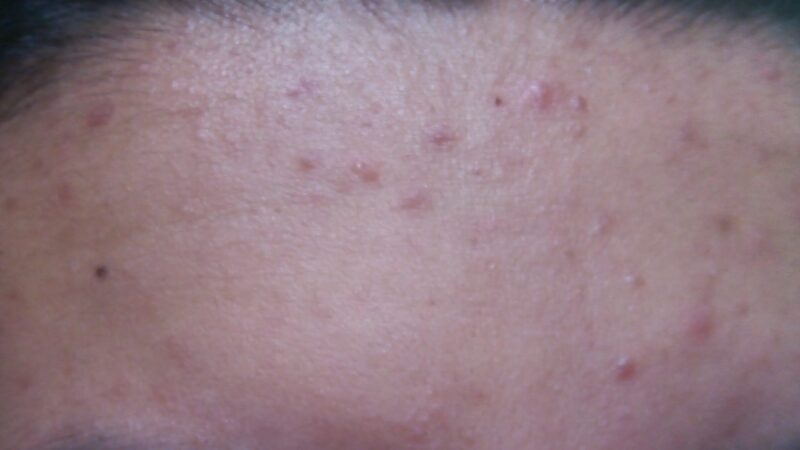 Heat Rash Self-Care: How to Identify, Treat, and Avoid It