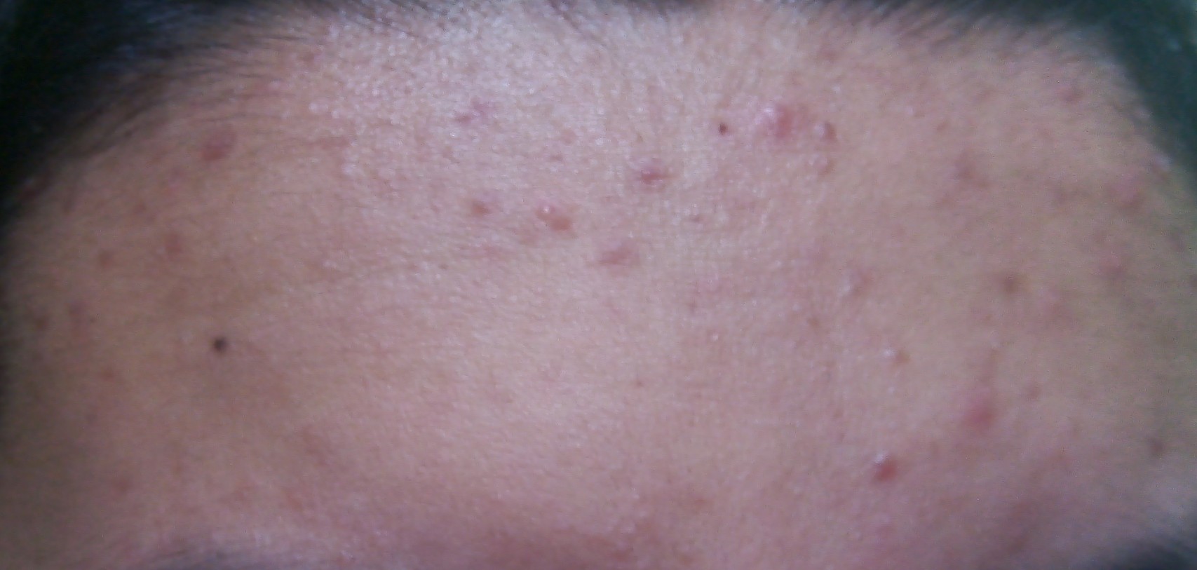 An example of heat rash self-care is a woman's forehead with obvious heat rash.