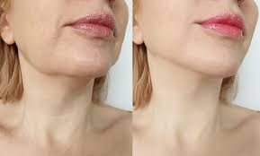 This image shows a weak and sharp jawline of woman and symbolizing the aftereffects of Mewing.